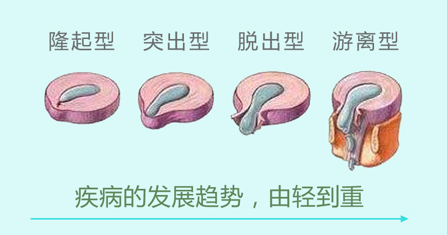 腰椎间盘突出症