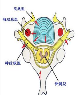 颈椎病